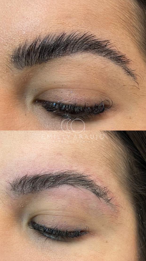 Antes e depois de despigmentação de sobrancelhas