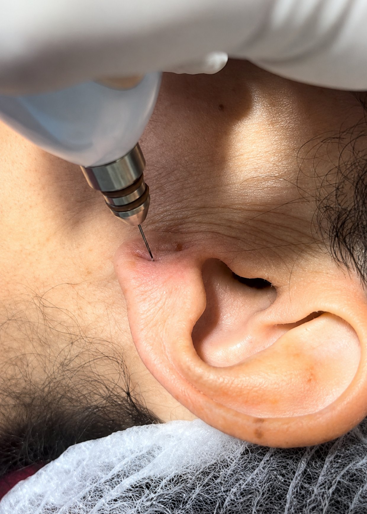 Lobulomodelação do lóbulo da orelha com jato de plasma