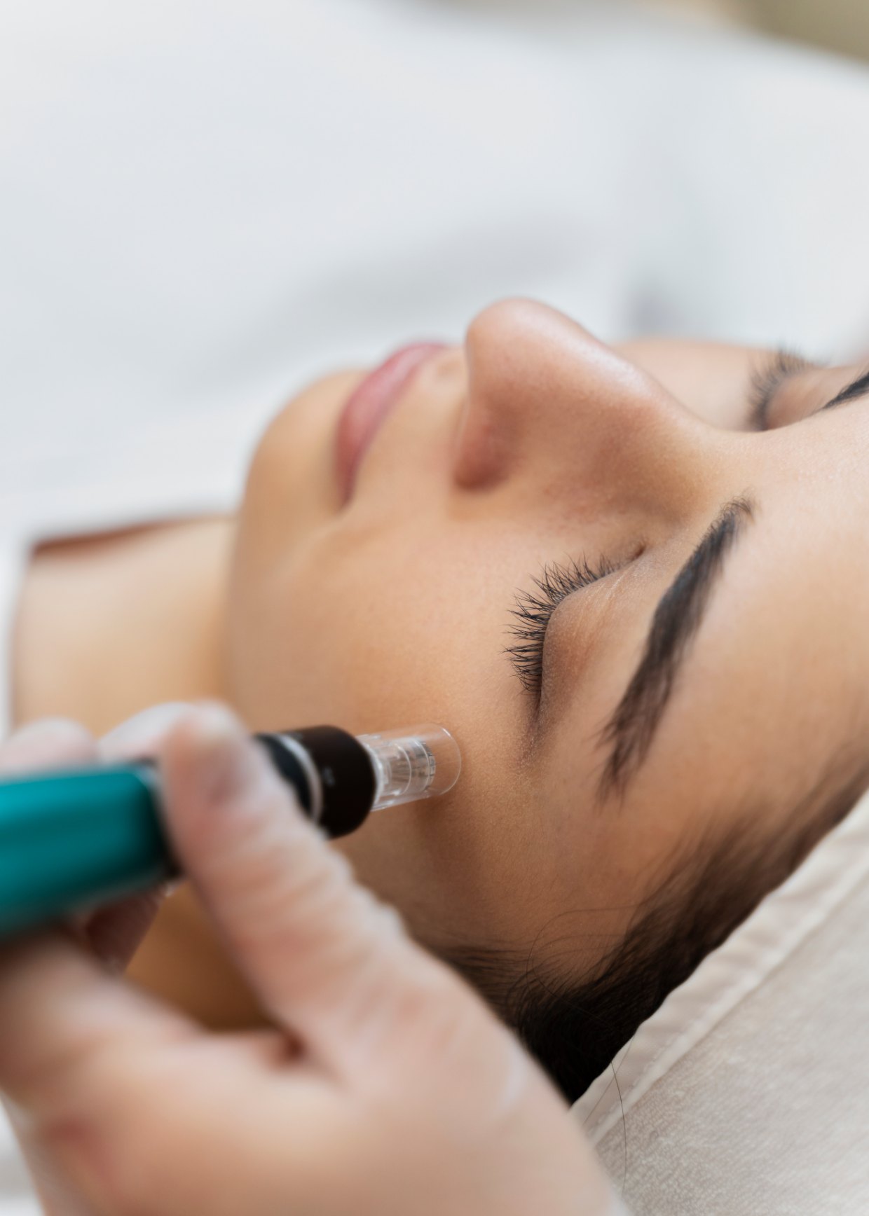 Sessão de microagulhamento facial com dermapen