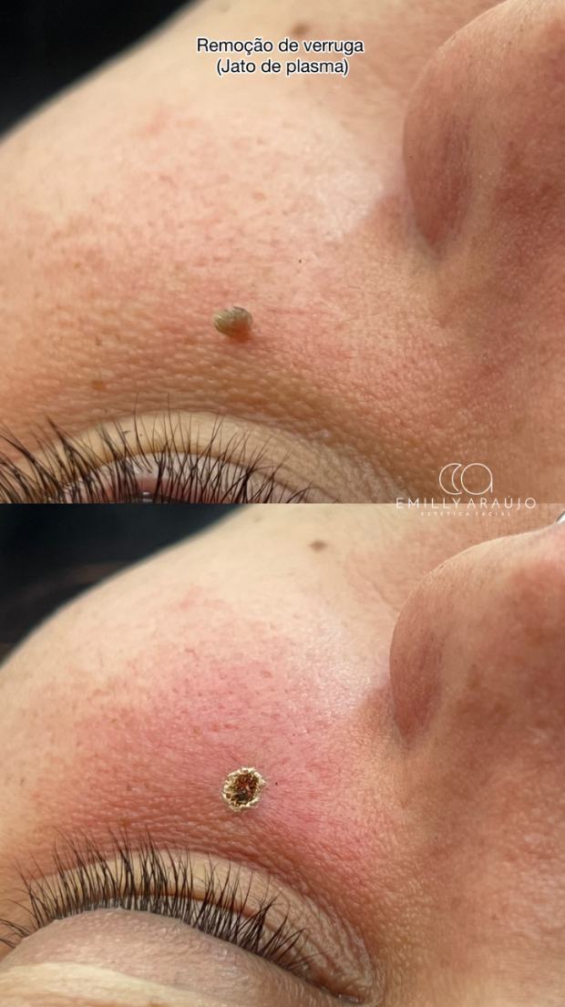 Antes e depois de remoção de verruga com jato de plasma