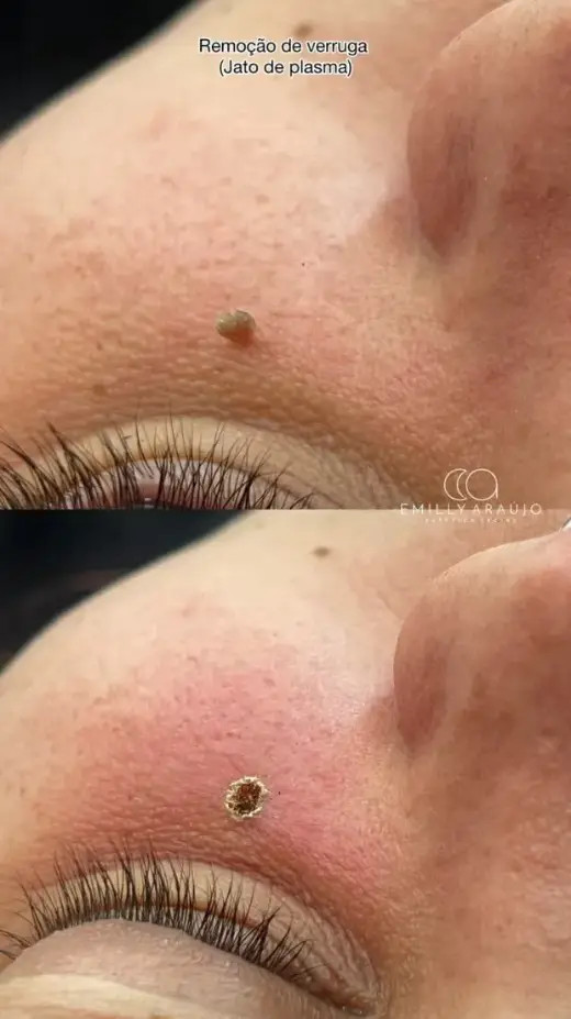 Antes e depois de remoção de verruga com jato de plasma